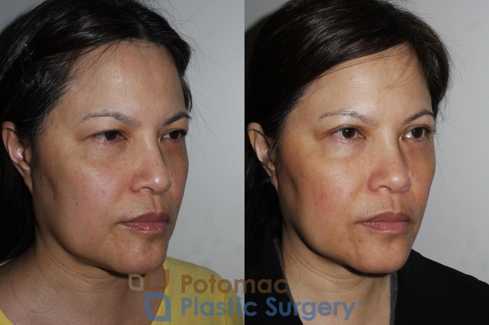 Before & After Blepharoplasty (Eyelid Surgery) Case 170 Right Oblique View in Washington DC & Arlington , DC