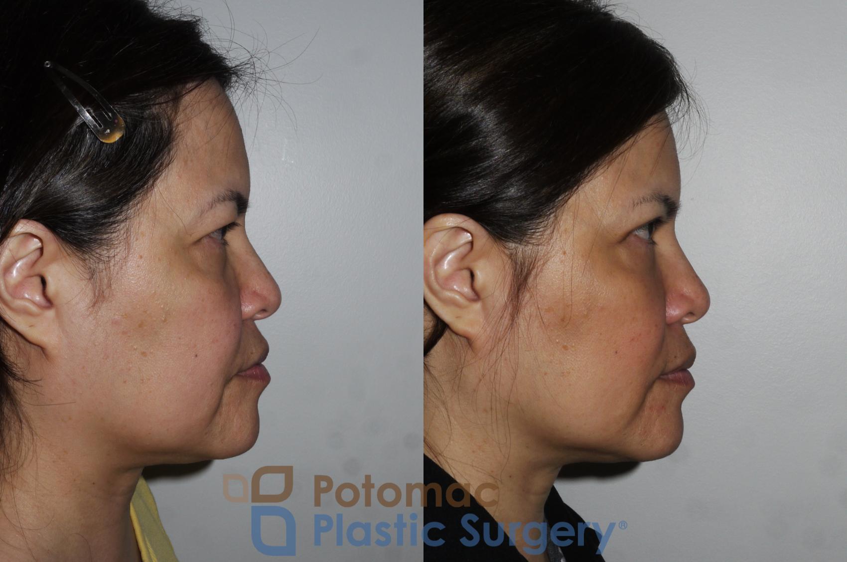 Before & After Blepharoplasty Case 170 Right Side View in Washington, DC
