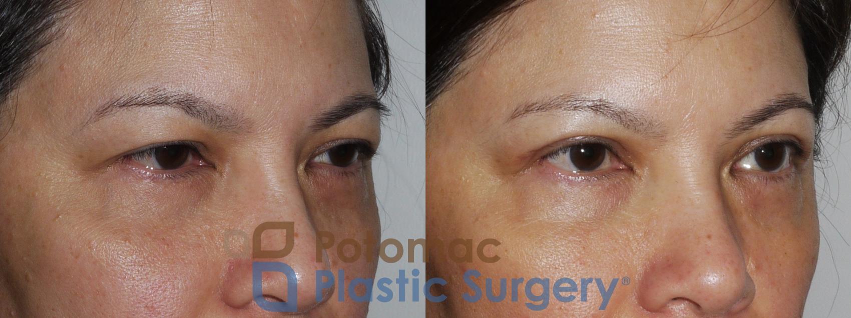 Before & After Blepharoplasty Case 170 View #7 View in Washington, DC