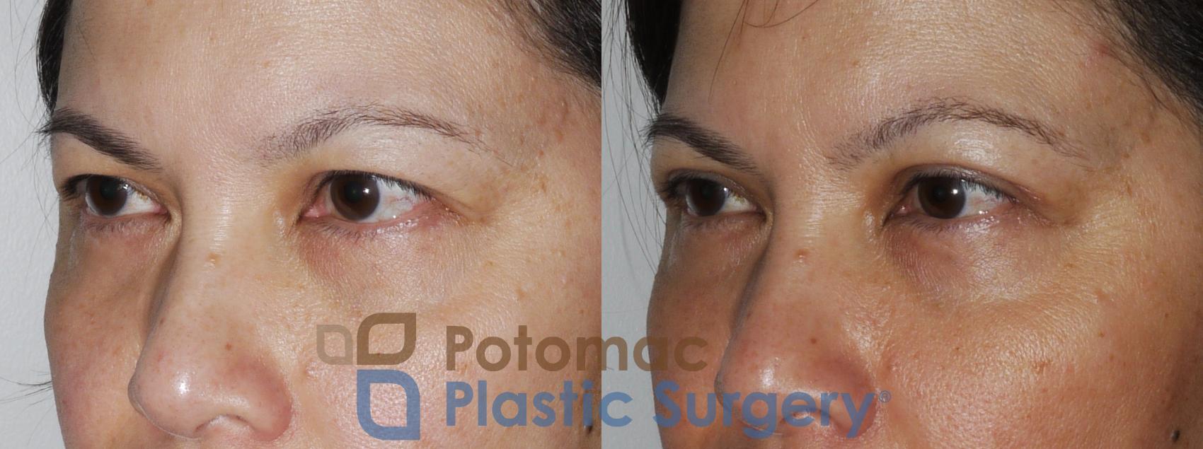 Before & After Asian Eyelid Surgery Case 170 View #8 View in Washington, DC
