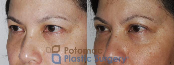 Before & After Blepharoplasty Case 170 View #8 View in Washington DC & Arlington , DC