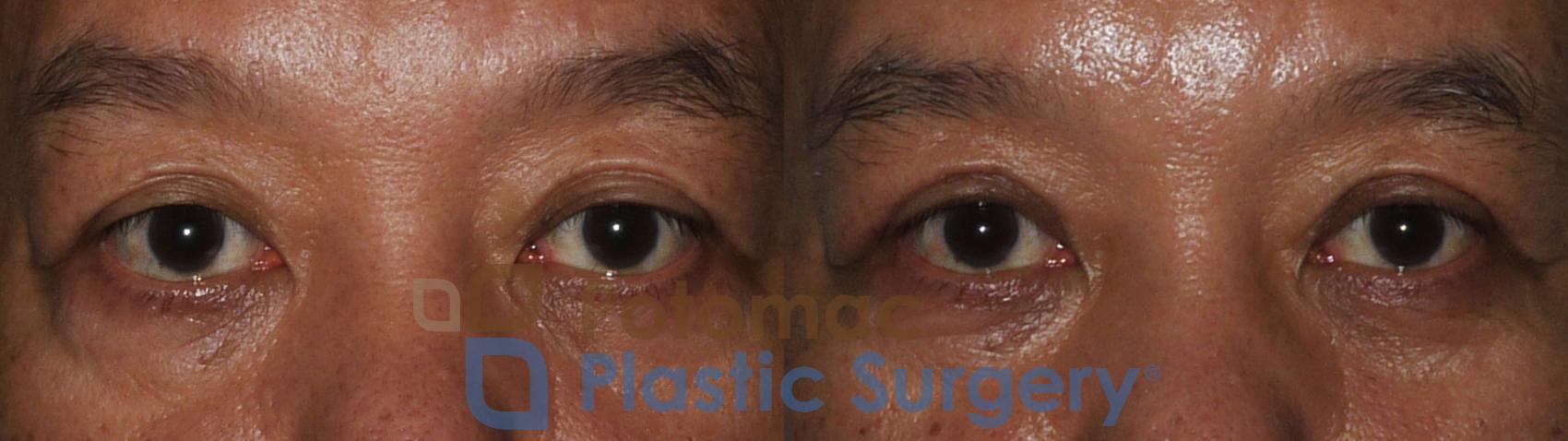 Appearance of a high double eyelid fold. The surgically created