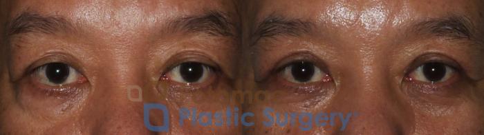 Before & After Asian Eyelid Surgery Case 184 Front View in Washington, DC