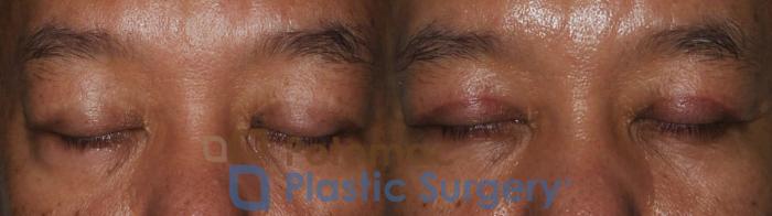 Before & After Blepharoplasty Case 184 Front View #2 View in Washington DC & Arlington , DC