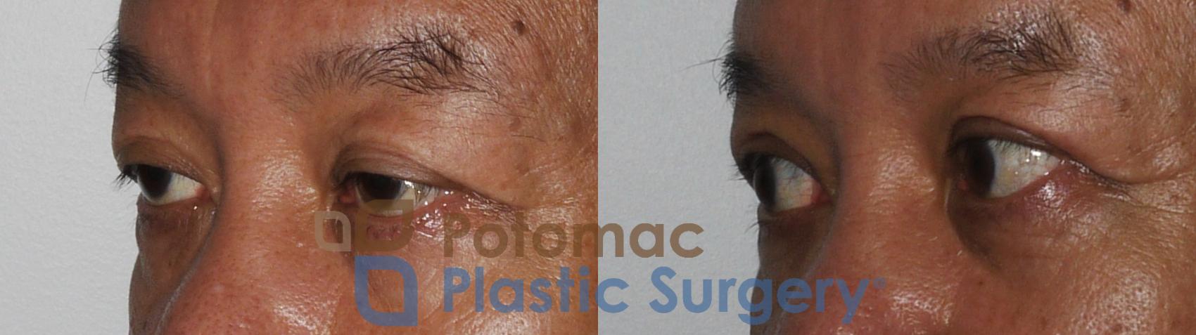 Before & After Asian Eyelid Surgery Case 184 Left Oblique View in Washington, DC