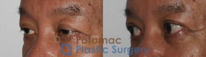 Before & After Blepharoplasty Case 184 Left Oblique View in Washington DC & Arlington , DC