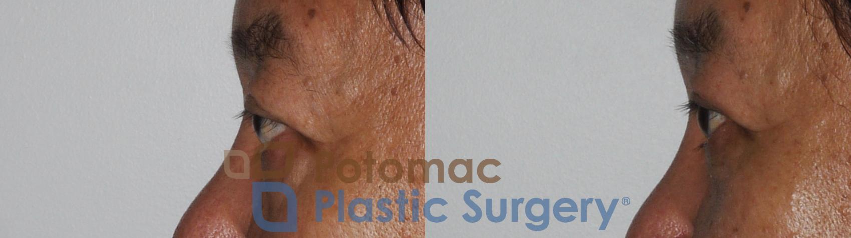 Before & After Asian Eyelid Surgery Case 184 Left Side View in Washington, DC
