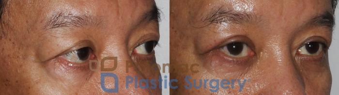 Before & After Blepharoplasty Case 184 Right Oblique View in Washington DC & Arlington , DC
