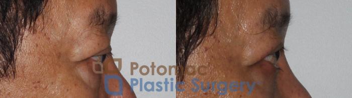 Before & After Blepharoplasty Case 184 Right Side View in Washington DC & Arlington , DC