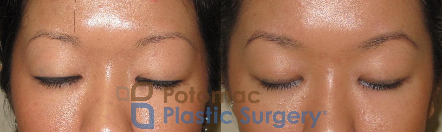 Before & After Blepharoplasty (Eyelid Surgery) Case 21 Front #2 View in Washington DC & Arlington , DC