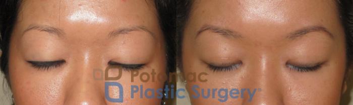 Before & After Asian Eyelid Surgery Case 21 Front #2 View in Washington DC & Arlington , DC