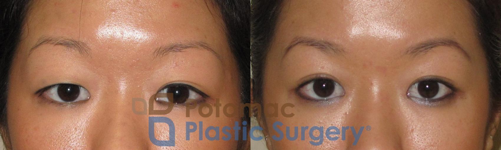 Before & After Asian Eyelid Surgery Case 21 Front View in Washington, DC