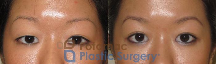Before & After Blepharoplasty Case 21 Front View in Washington DC & Arlington , DC
