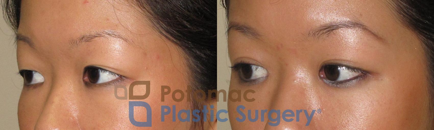 Before & After Blepharoplasty (Eyelid Surgery) Case 21 Left Oblique View in Washington DC & Arlington , DC