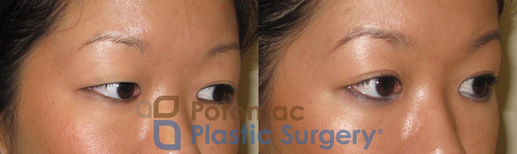 Before & After Blepharoplasty (Eyelid Surgery) Case 21 Right Oblique View in Washington DC & Arlington , DC