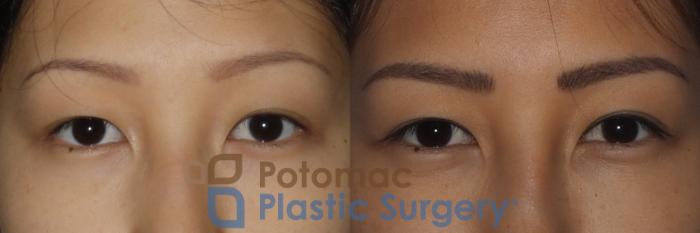 Before & After Asian Eyelid Surgery Case 213 Front View #1 View in Washington, DC