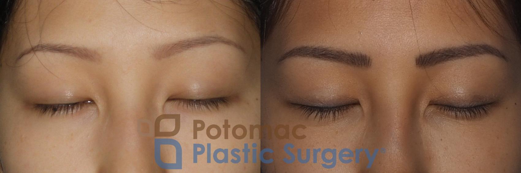 Before & After Asian Eyelid Surgery Case 213 Front View #2 View in Washington, DC