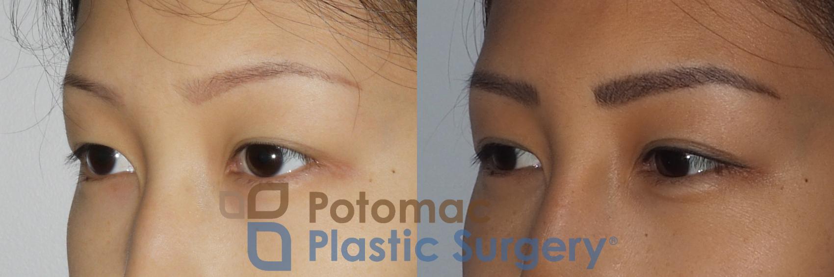 Before & After Asian Eyelid Surgery Case 213 Left Oblique View in Washington, DC