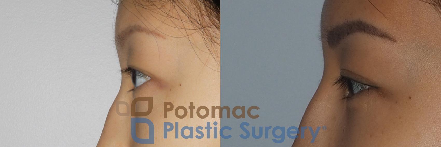 Before & After Asian Eyelid Surgery Case 213 Left Side View in Washington, DC