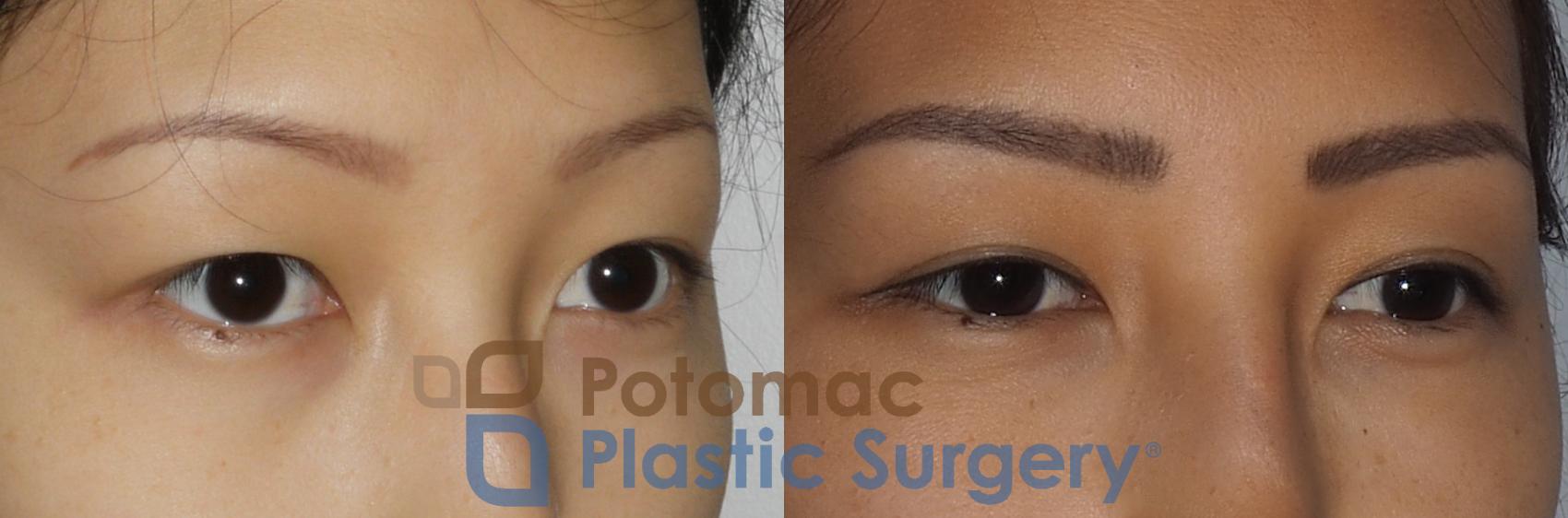 Before & After Blepharoplasty Case 213 Right Oblique View in Washington, DC