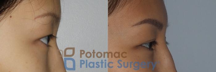 Before & After Asian Eyelid Surgery Case 213 Right Side View in Washington, DC