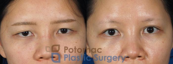 Before & After Asian Eyelid Surgery Case 236 Front View #1 View in Washington, DC
