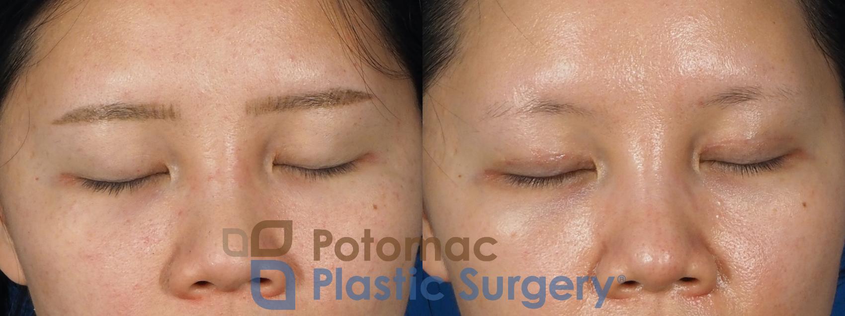 Before & After Asian Eyelid Surgery Case 236 Front View #2 View in Washington DC & Arlington , DC