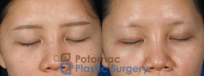 Before & After Asian Eyelid Surgery Case 236 Front View #2 View in Washington, DC
