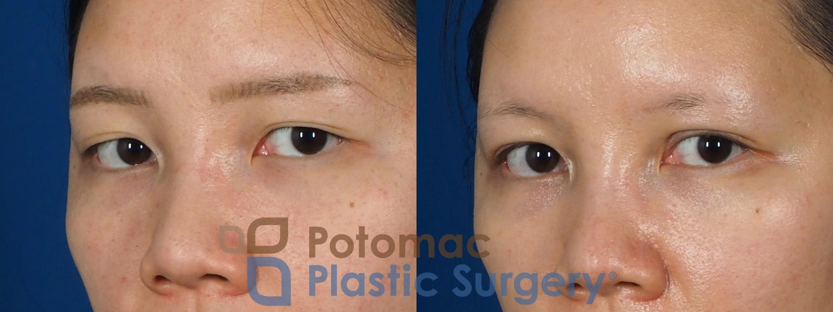Before & After Asian Eyelid Surgery Case 236 Left Oblique View in Washington DC & Arlington , DC