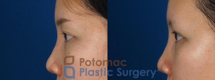 Before & After Asian Eyelid Surgery Case 236 Left Side View in Washington, DC