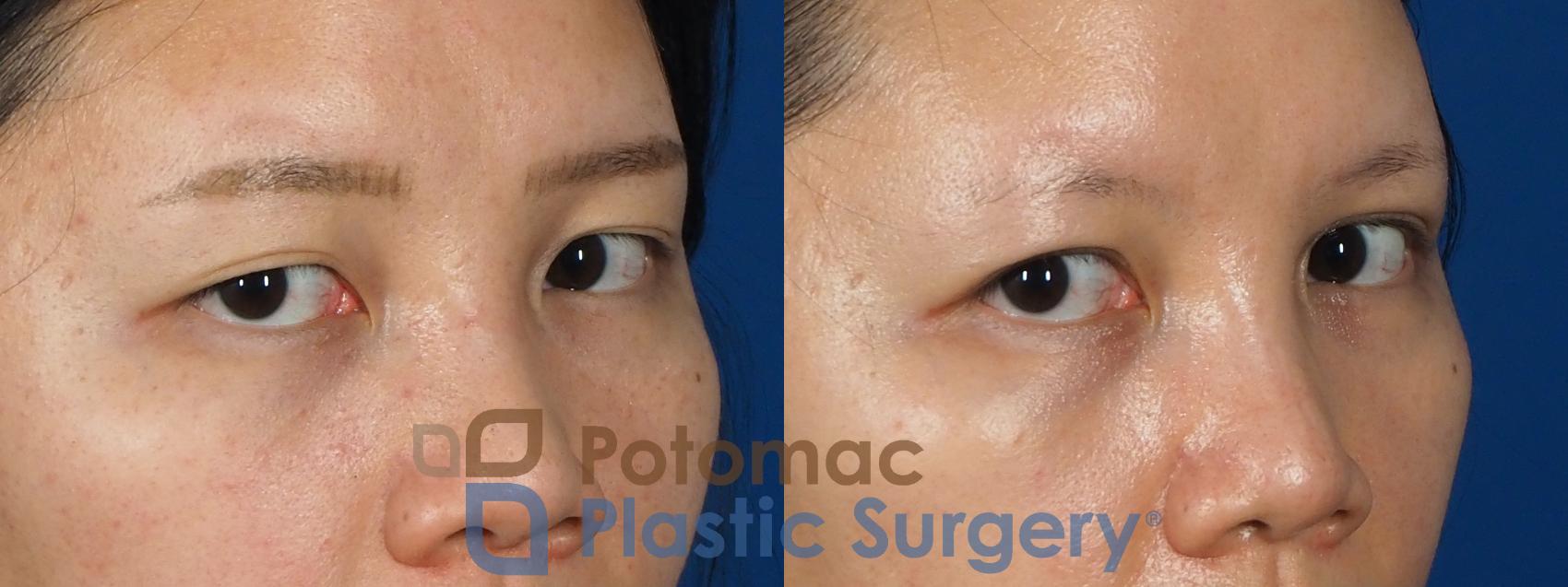 Before & After Asian Eyelid Surgery Case 236 Right Oblique View in Washington DC & Arlington , DC