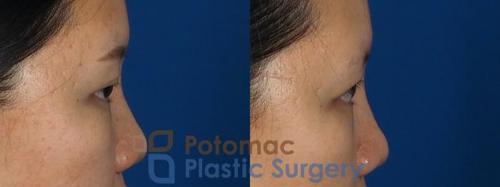 Before & After Asian Eyelid Surgery Case 236 Right Side View in Washington, DC