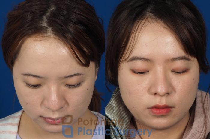 Before & After Blepharoplasty Case 254 Above View in Washington DC & Arlington , DC