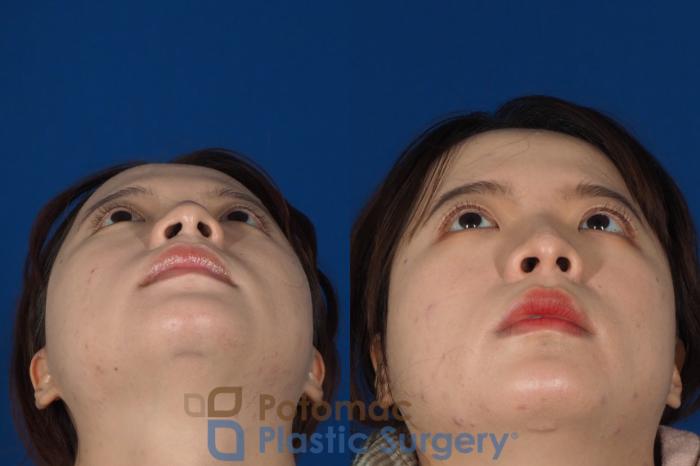 Before & After Blepharoplasty Case 254 Below View in Washington DC & Arlington , DC