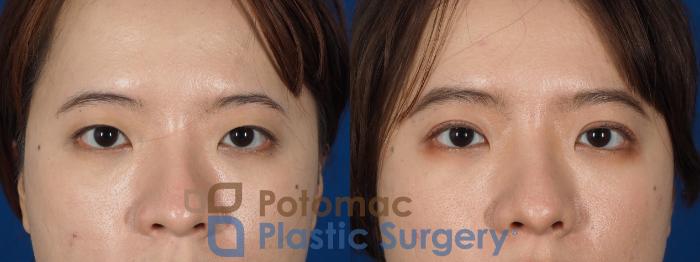 Before & After Blepharoplasty Case 254 Front Close-Up View #1 View in Washington DC & Arlington , DC