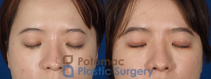 Before & After Asian Eyelid Surgery Case 254 Front Close-Up View #2 View in Washington DC & Arlington , DC