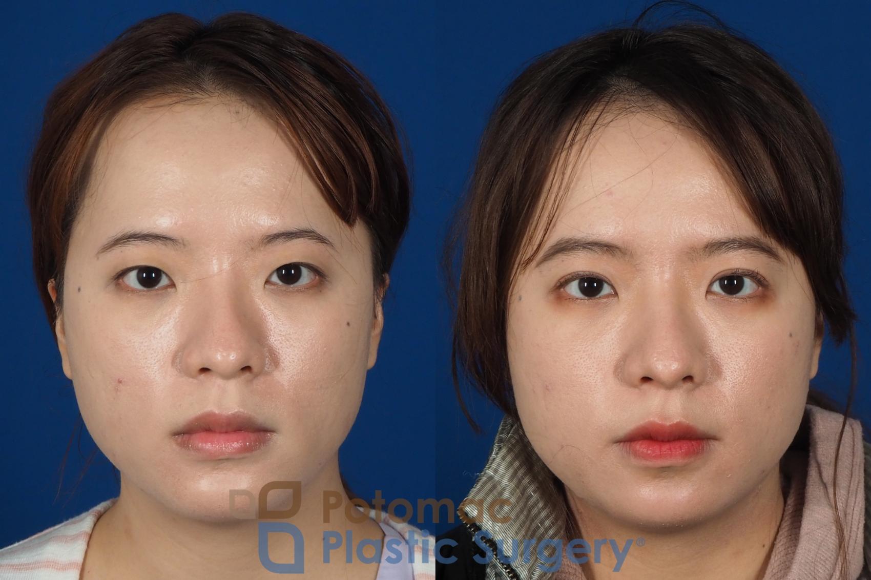 Before & After Asian Eyelid Surgery Case 254 Front View #1 View in Washington, DC