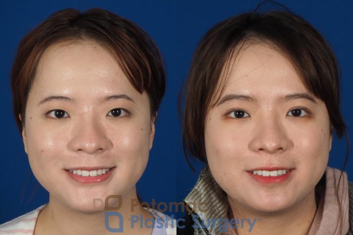 Before & After Asian Eyelid Surgery Case 254 Front View #2 View in Washington DC & Arlington , DC