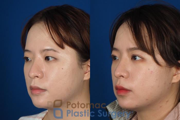 Before & After Asian Eyelid Surgery Case 254 Left Oblique View in Washington DC & Arlington , DC