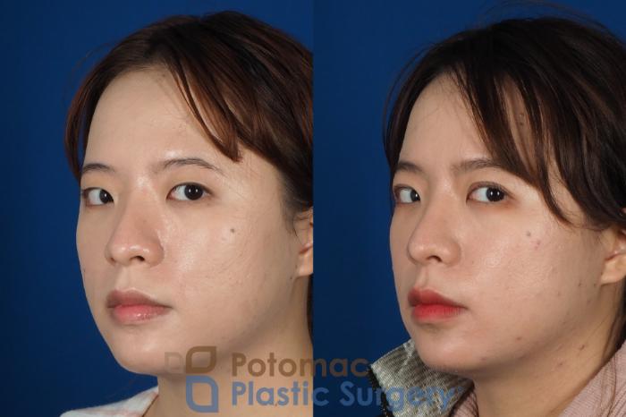 Before & After Asian Eyelid Surgery Case 254 Left Oblique View #2 View in Washington DC & Arlington , DC