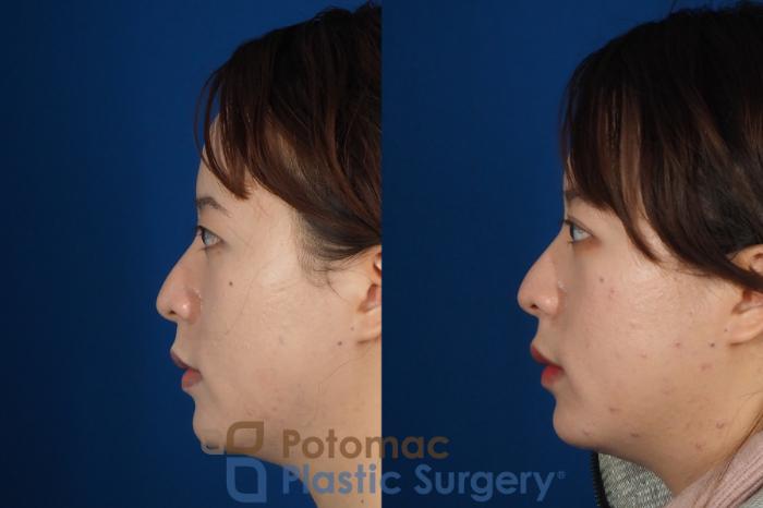 Before & After Asian Eyelid Surgery Case 254 Left Side View in Washington DC & Arlington , DC