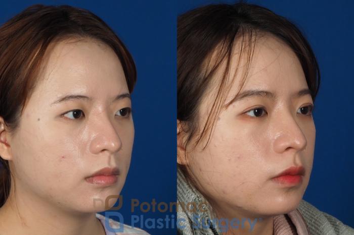 Before & After Blepharoplasty Case 254 Right Oblique View in Washington DC & Arlington , DC