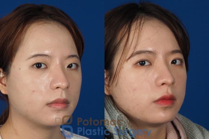 Before & After Asian Eyelid Surgery Case 254 Right Oblique View #2 View in Washington DC & Arlington , DC