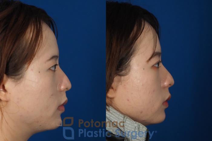 Before & After Blepharoplasty Case 254 Right Side View in Washington DC & Arlington , DC
