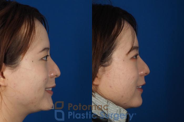 Before & After Asian Eyelid Surgery Case 254 Right Side View #2 View in Washington DC & Arlington , DC