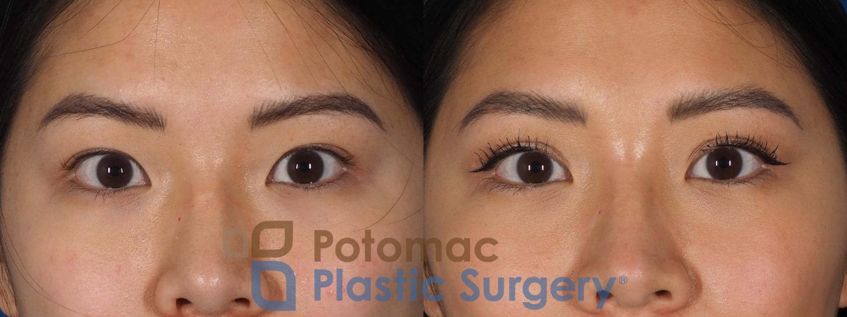 Before & After Blepharoplasty Case 281 Front View in Washington, DC