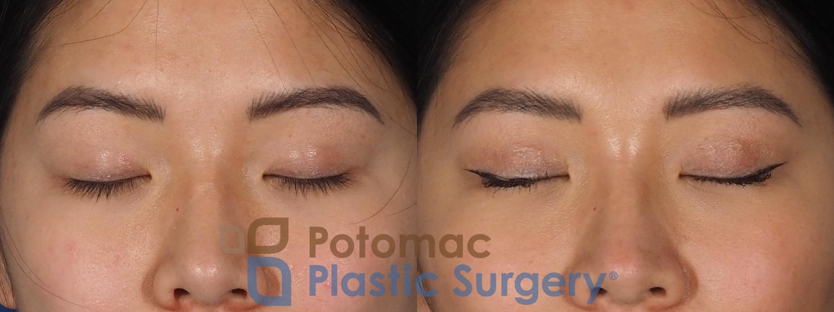 Before & After Asian Eyelid Surgery Case 281 Front - Eyes Closed View in Washington, DC