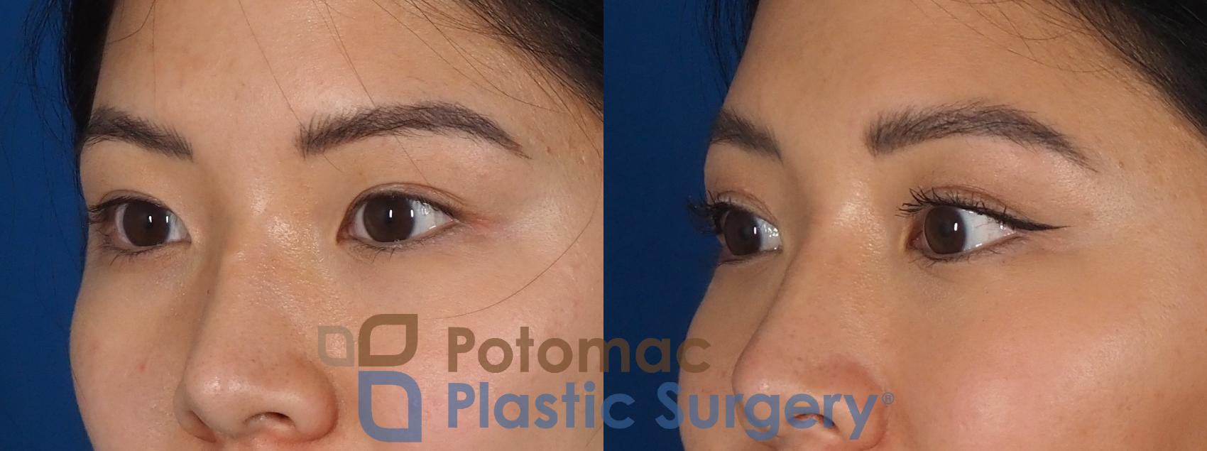 Before & After Asian Eyelid Surgery Case 281 Left Oblique View in Washington, DC