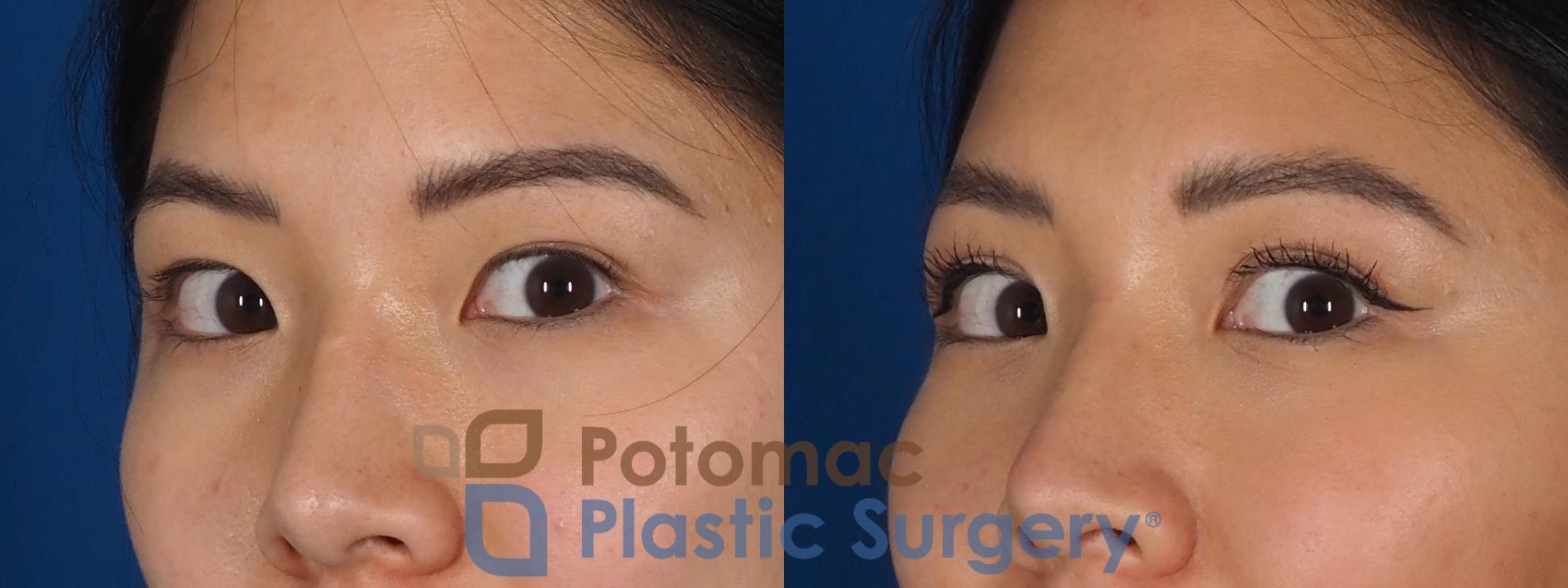 Before & After Asian Eyelid Surgery Case 281 Left Oblique - Looking View in Washington, DC