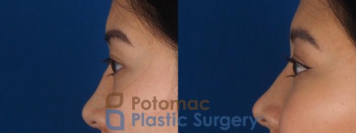 Before & After Asian Eyelid Surgery Case 281 Left Side View in Washington, DC